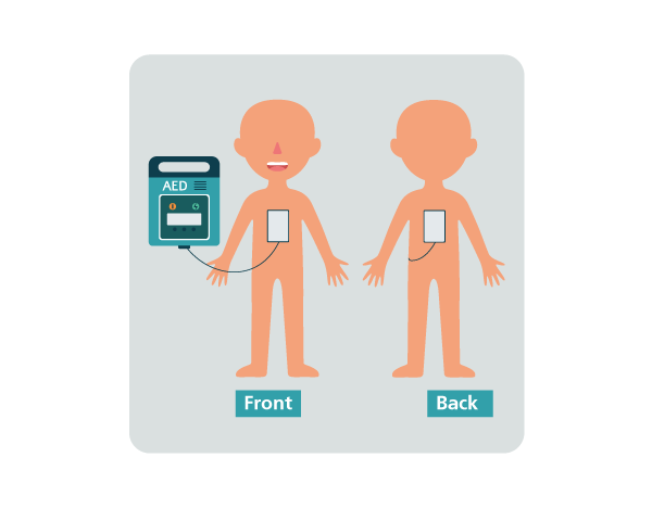 AED placement - child
