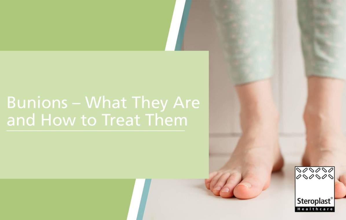 Bunions - What they are and how to treat them 