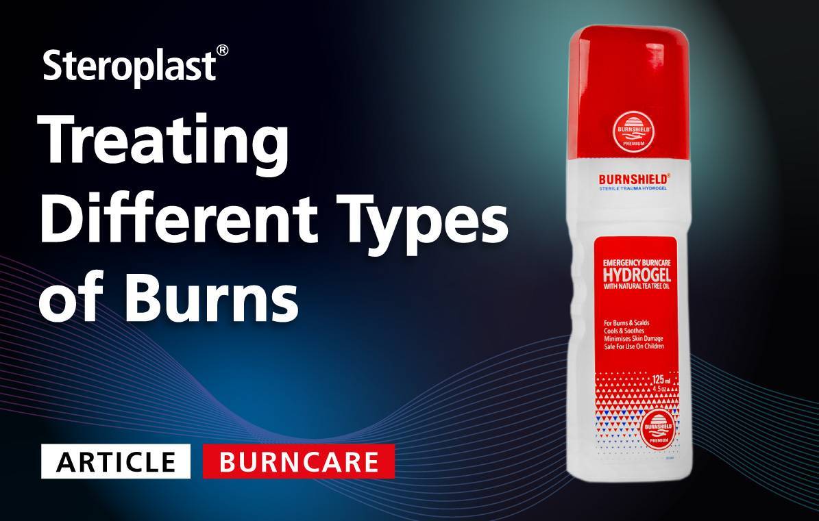 Treating Different Types of Burns