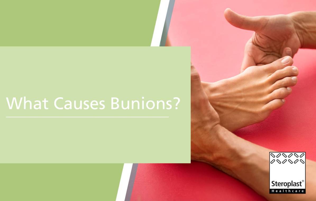 What Causes Bunions?