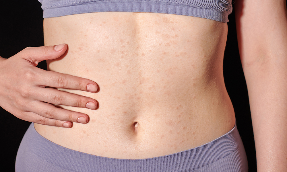 Allergic Contact Dermatitis