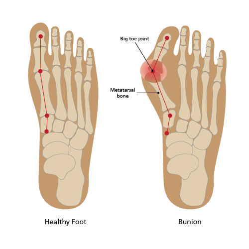 Bunion diagram