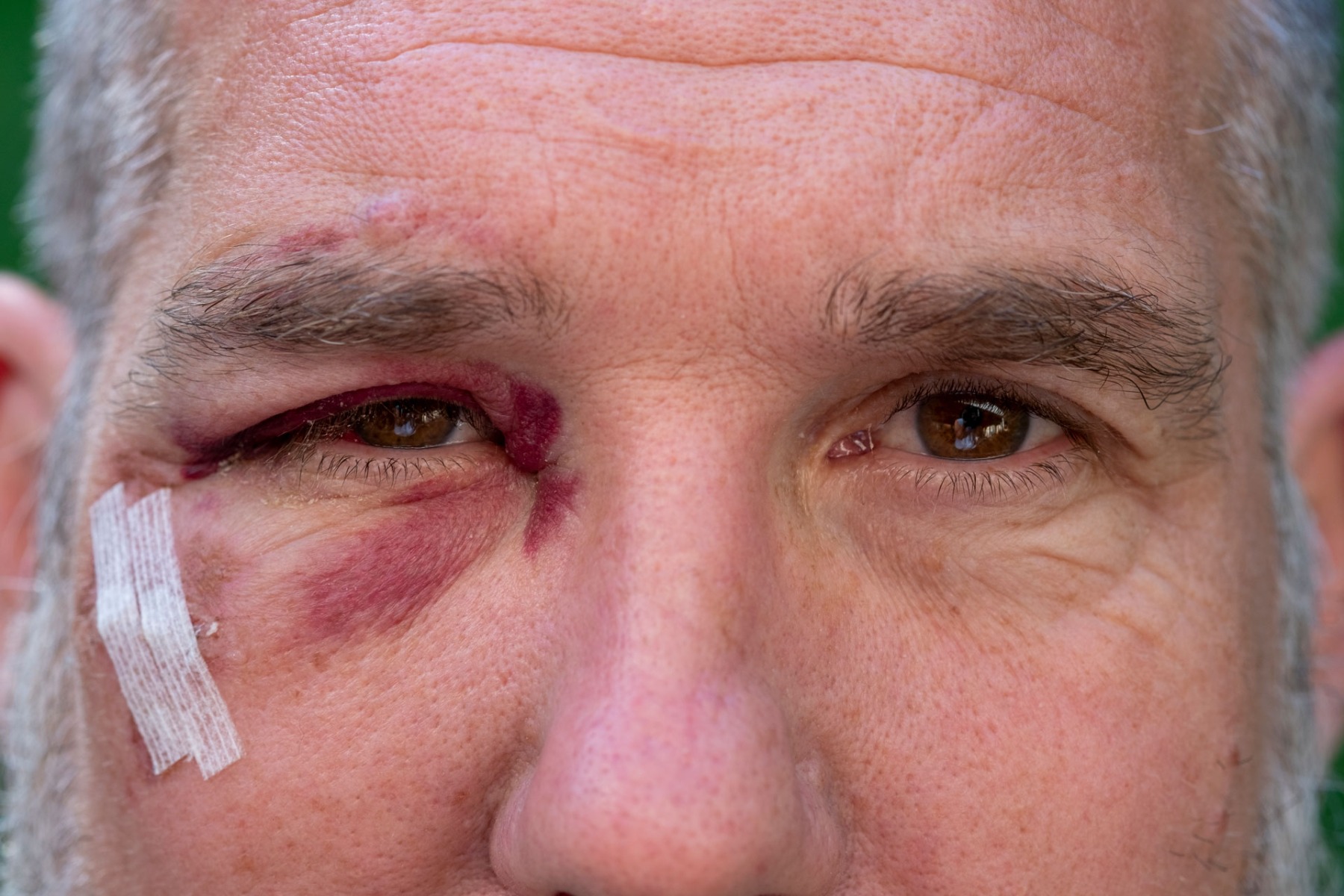 Close-up of man with black eye wound