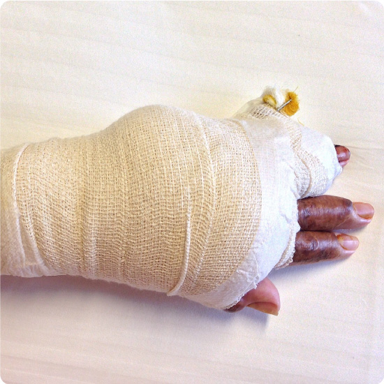 Blast Bandage being used on burns