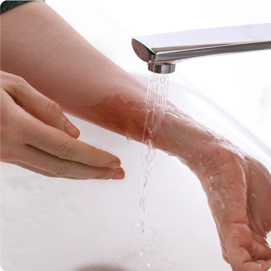 Someone soothing a burn on their arm by running it under the tap
