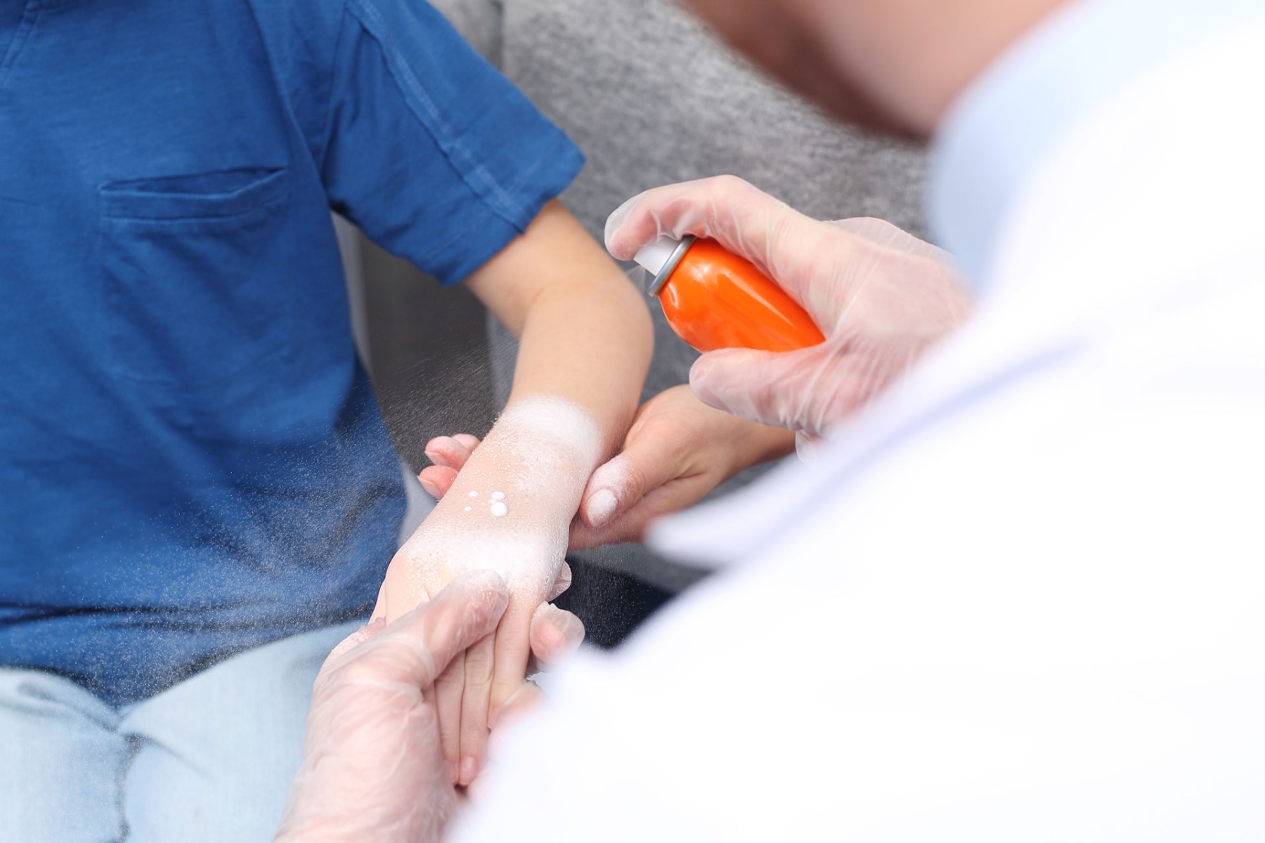 Burn dressing on a patient being sprayed with burn hydrogel