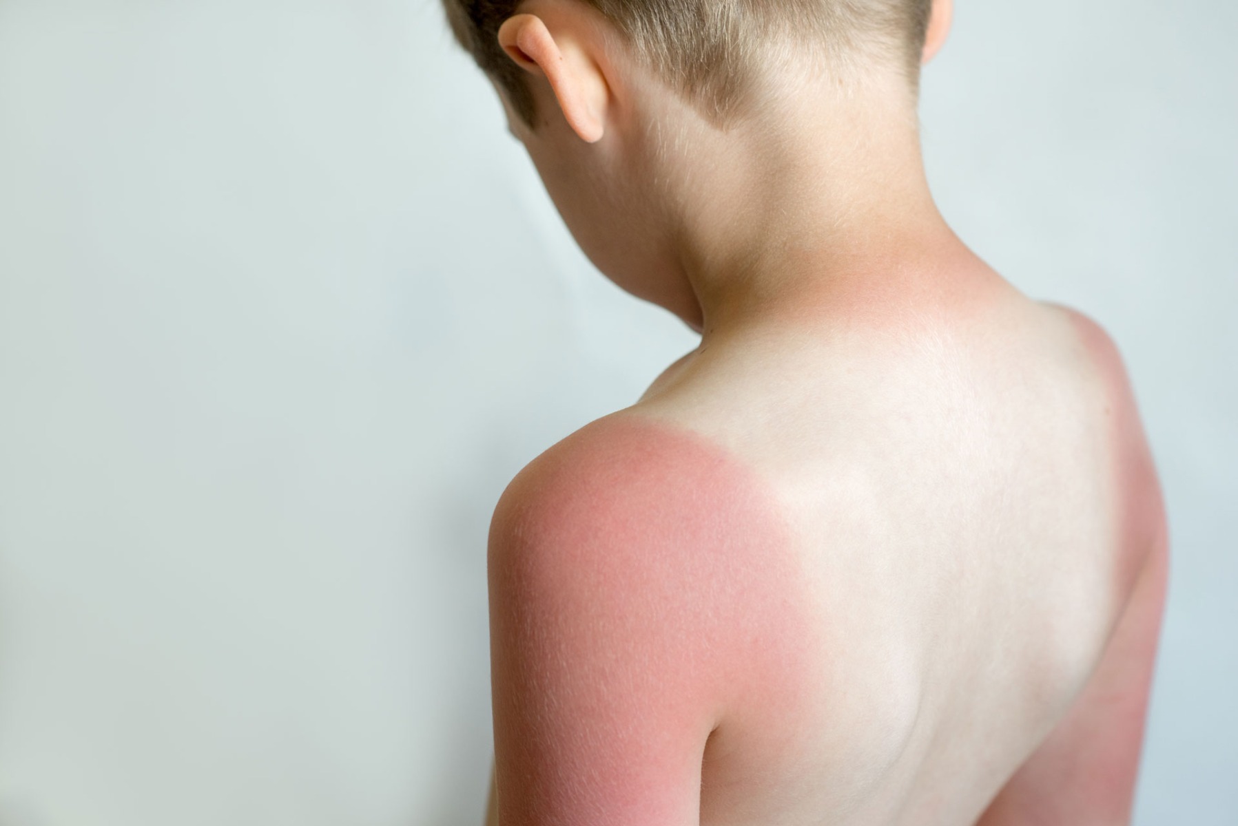 Sunburn on child's arms