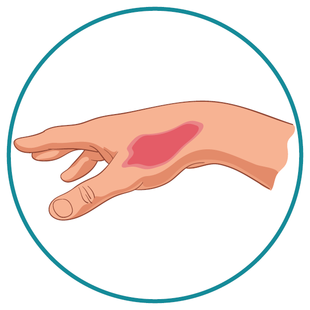 1st degree burns graphic