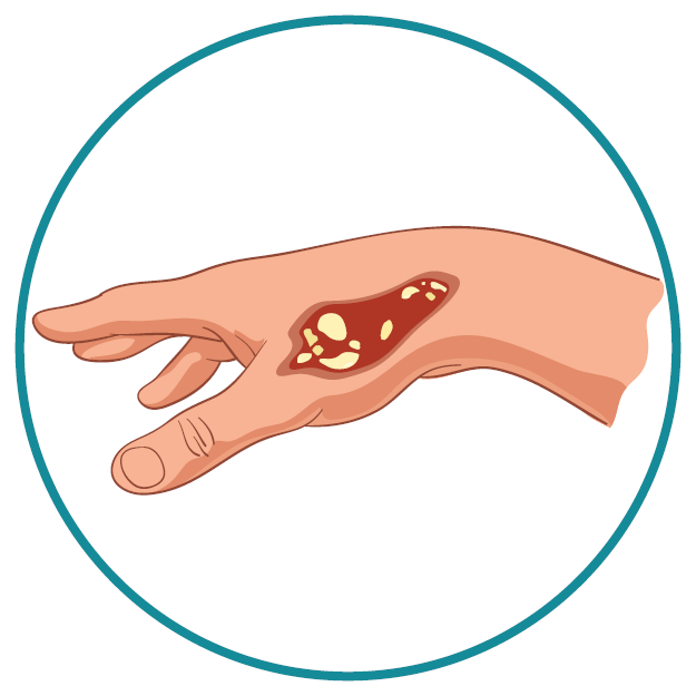 2nd degree burn graphic