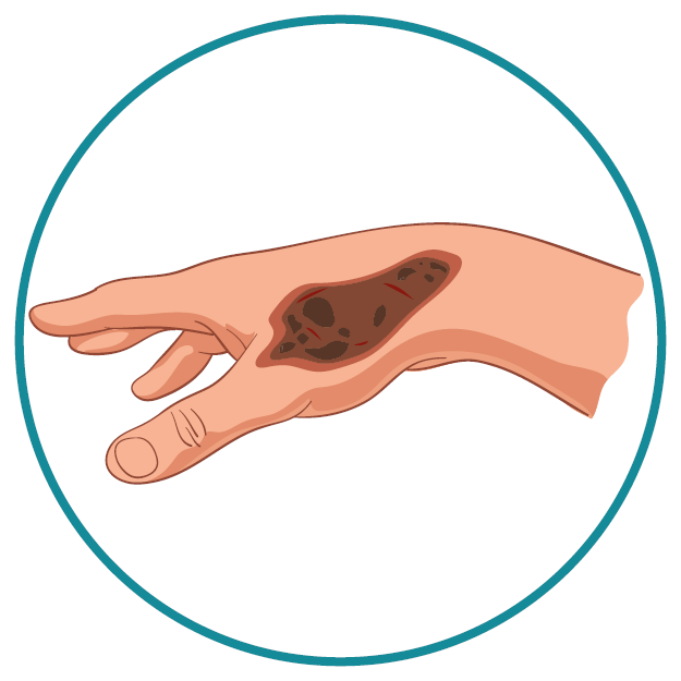 3rd degree burn graphic