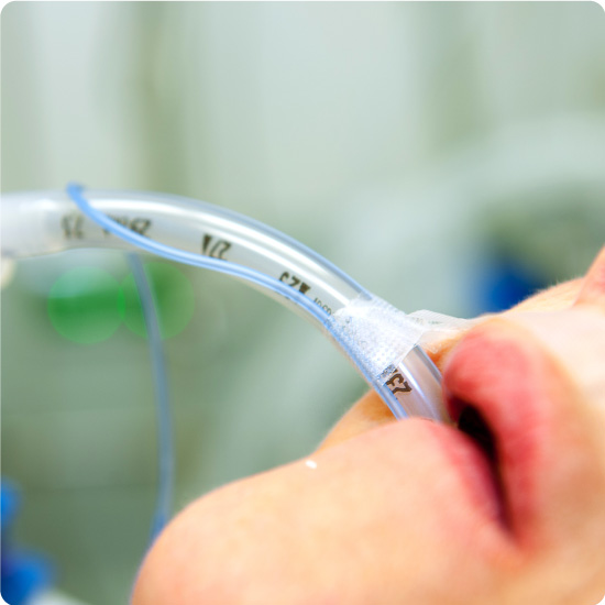 Endotracheal Tube Introducer
