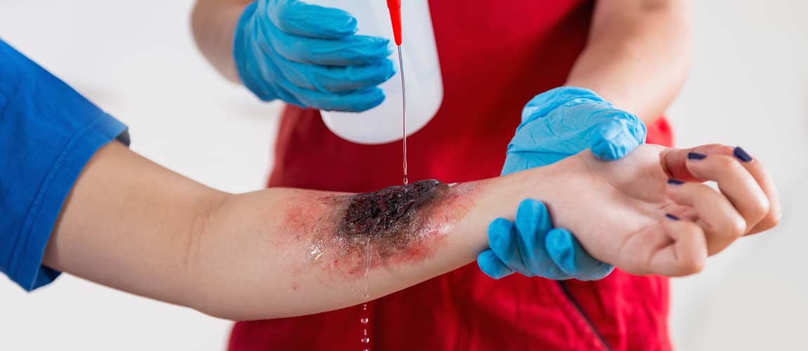 First aid paramedic in training, treating third degree burns