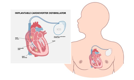 Pacemaker ICD Implantable Cardioverte Defibrillator Pulse Generator