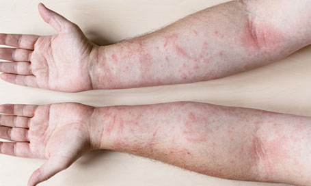 Irritant Contact Dermatitis