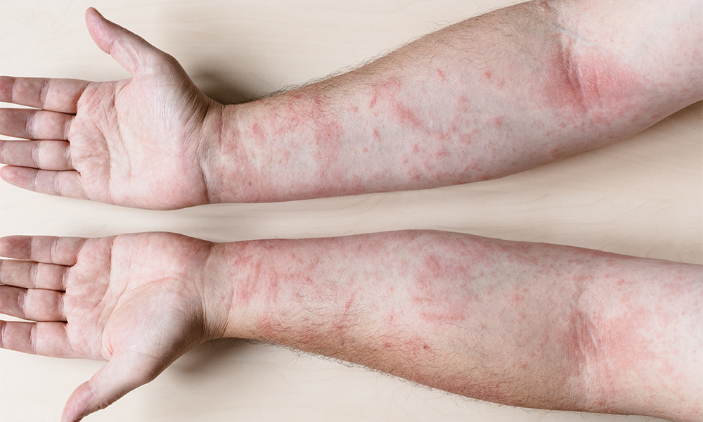 Irritant Contact Dermatitis