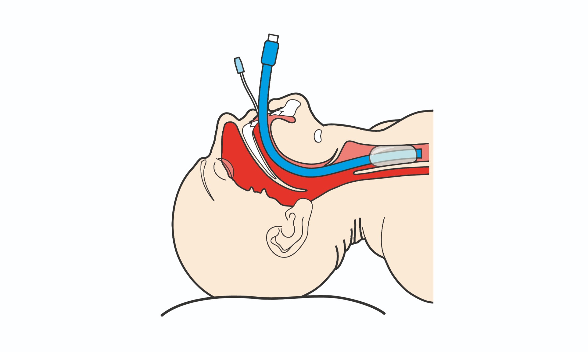 Laryngeal Tube