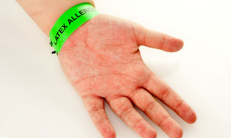 latex allergy on hand
