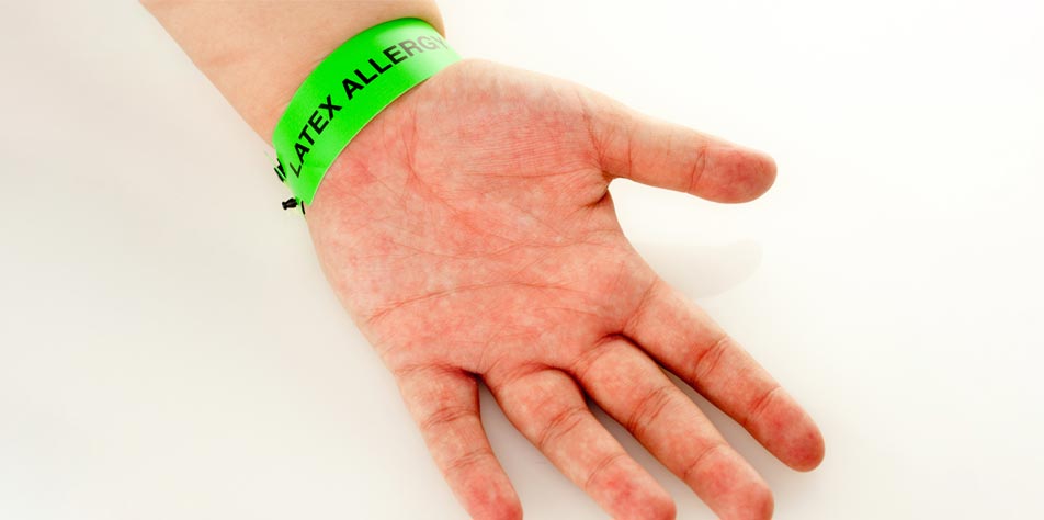 Latex allergy on the hand