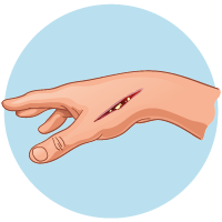 Pus coming from the wound