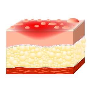 Illustrations depicting how deep a second degree burn is on the skin