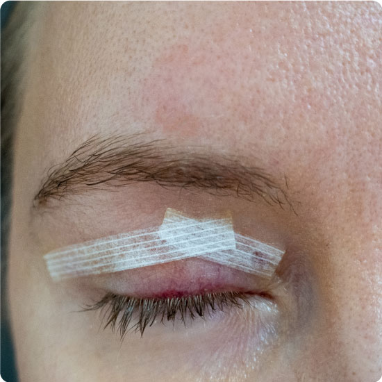 Sutures on Eye