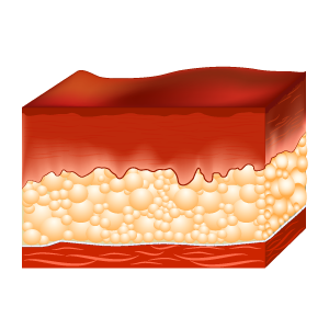 Illustrations depicting how deep a third degree burn is on the skin