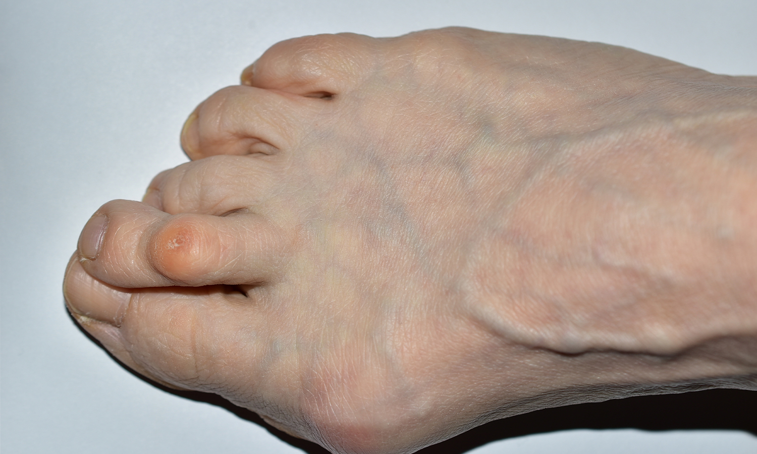 bunion on the top of the foot