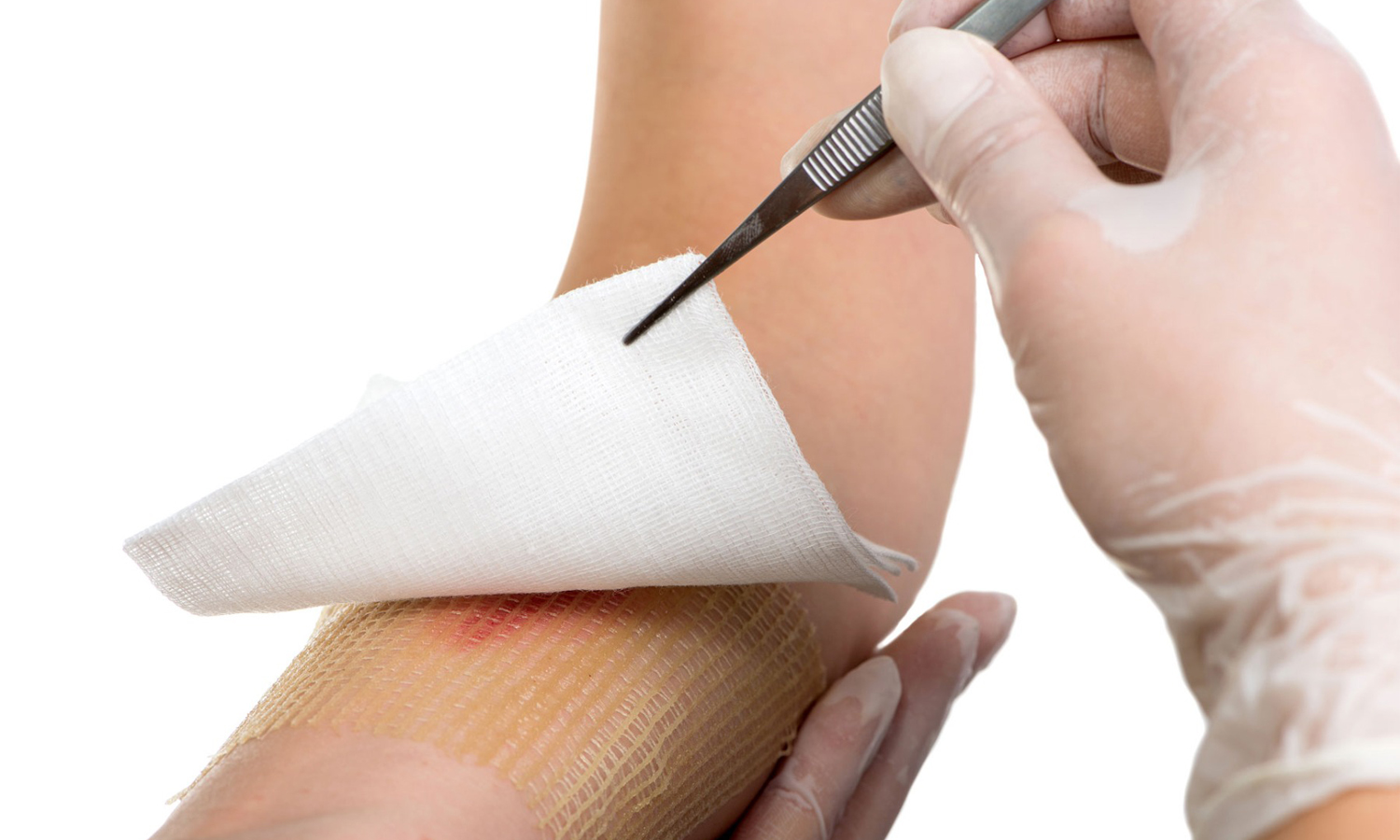 burnshield dressing on a patient’s arm