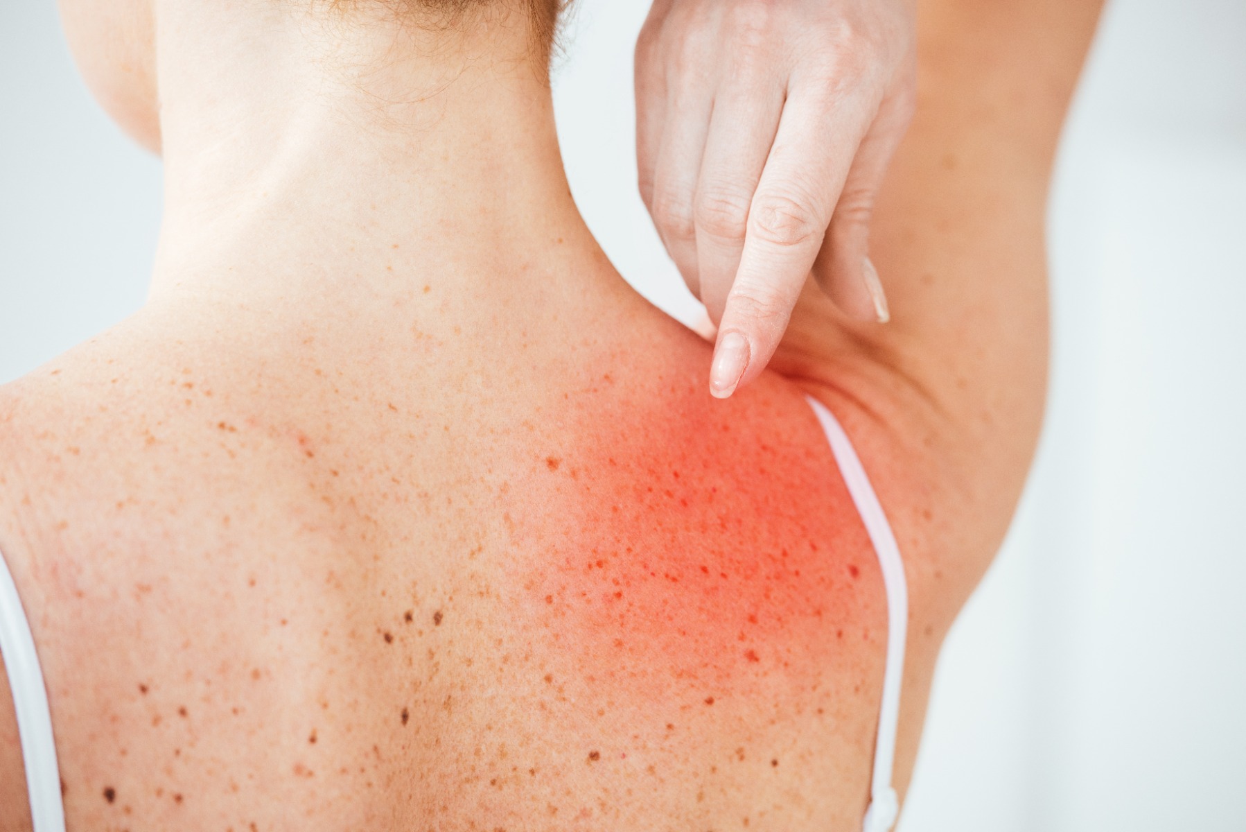 red irritated skin
