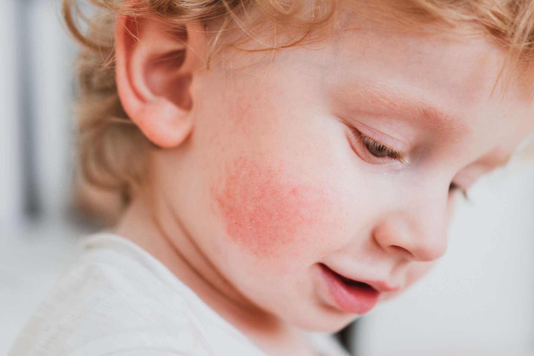 eczema on young child's face