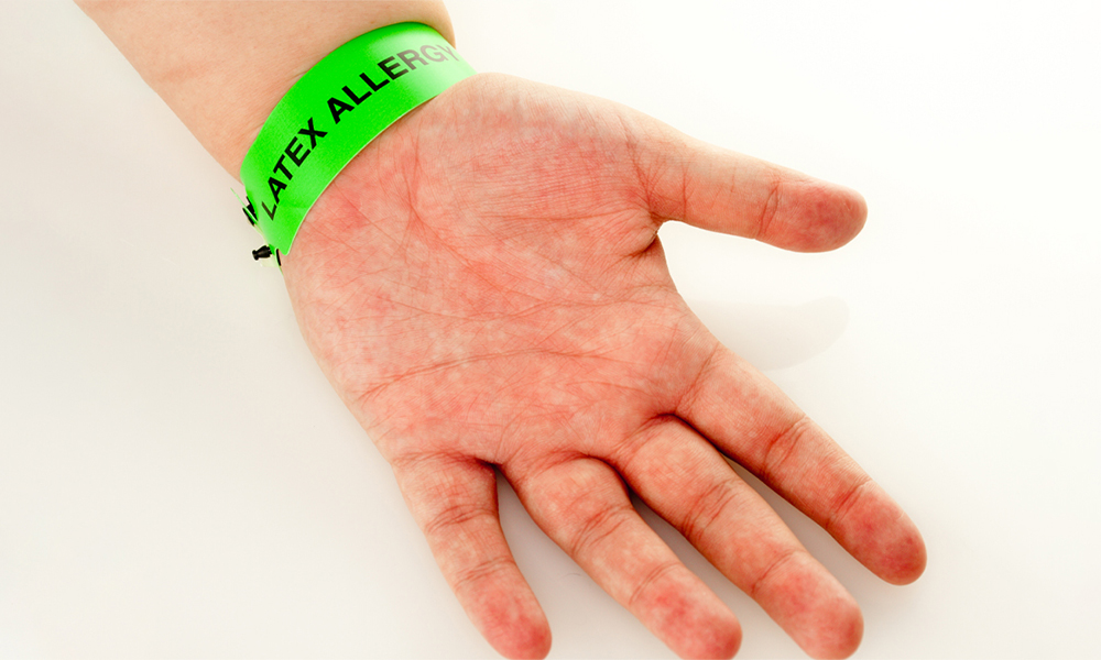latex allergy on hand