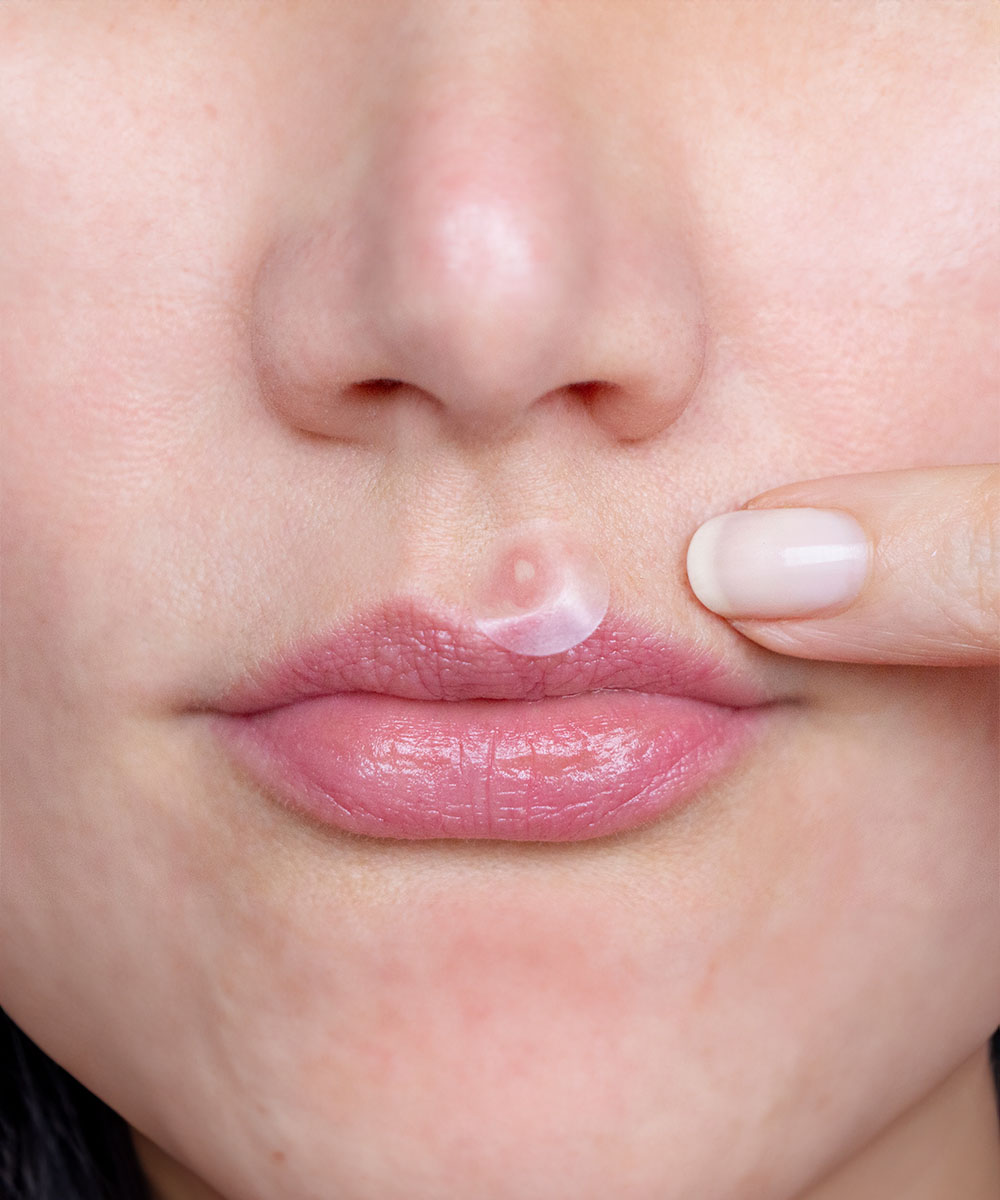 Woman applying spot plaster above lip