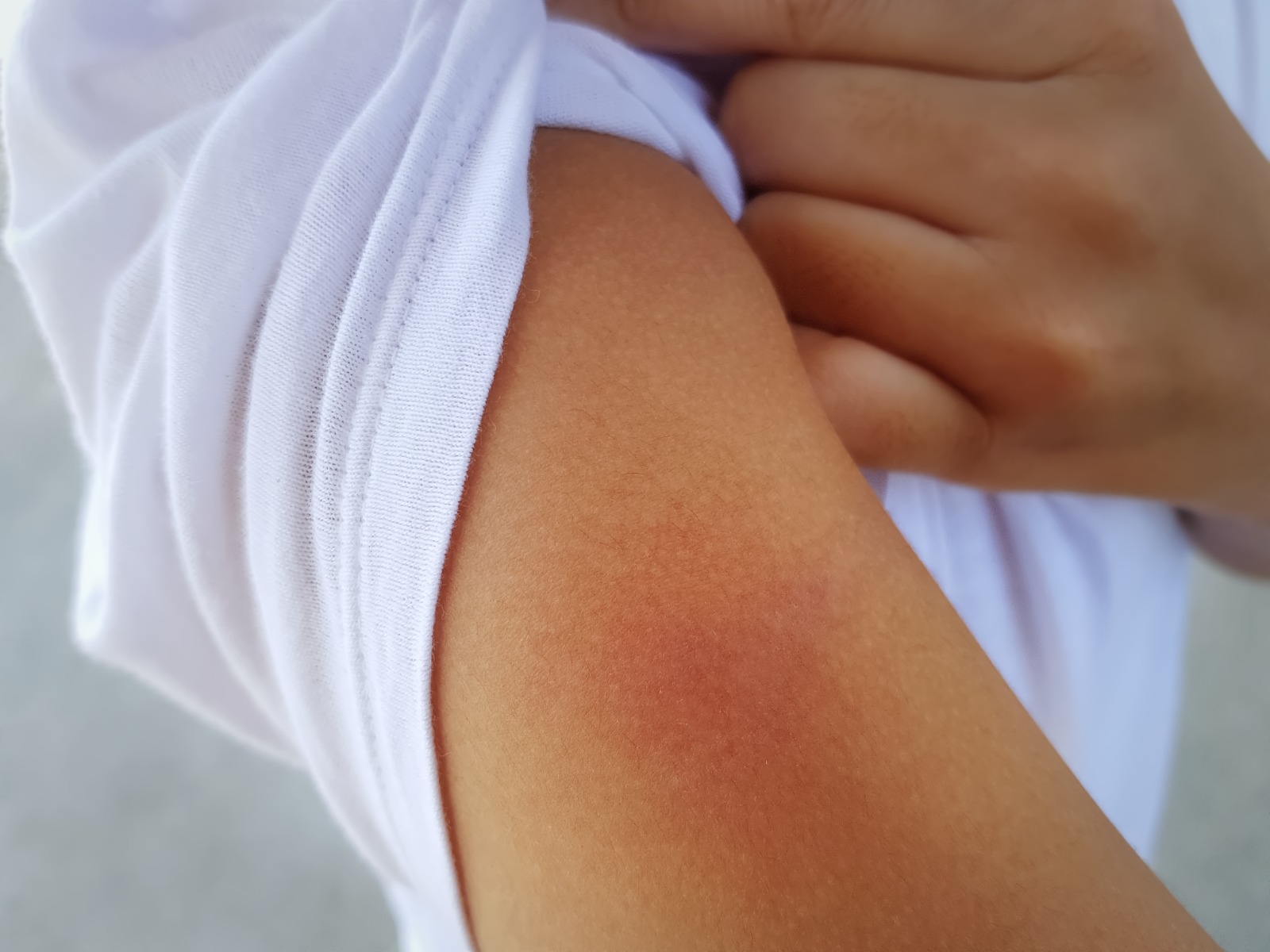 rash on persons arm