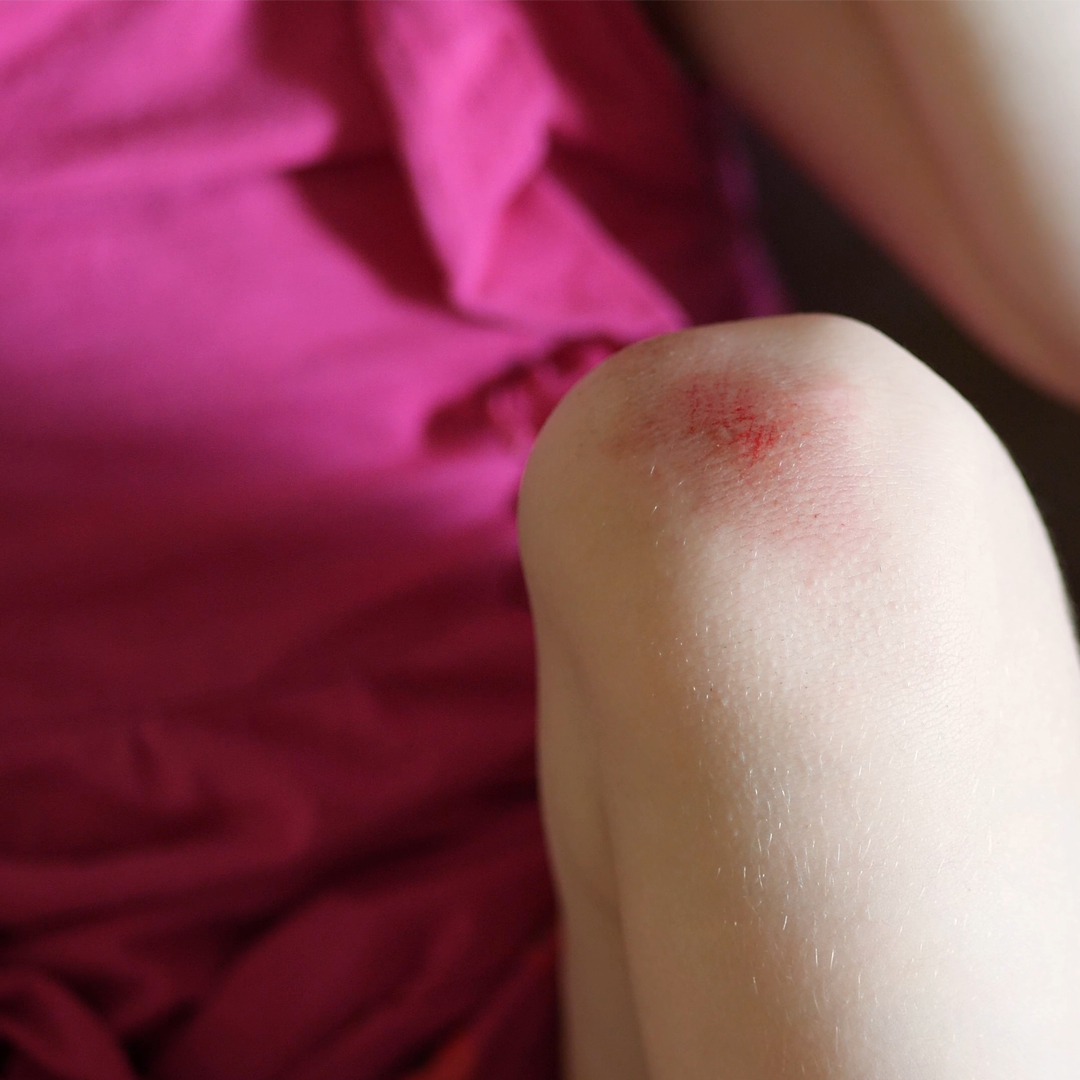 visibly_red_and_swollen